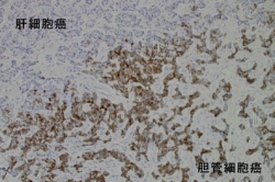 肝細胞癌と胆管細胞癌の混合型