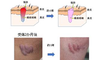 傷跡の経過