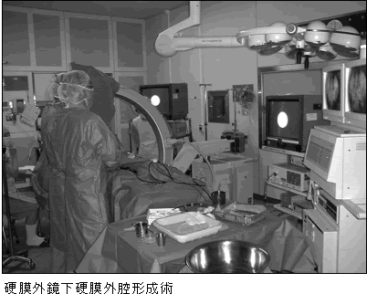 硬膜外鏡下硬膜外腔形成術