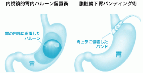内視鏡的胃内バルーン留置術 腹腔鏡下胃バンディング術